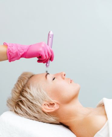 MICRONEEDLING by Dr. Chaitali Mondal in Kolkata (1) MICRONEEDLING-by-Dr MICRONEEDLING-by-Dr Microneedling MICRONEEDLING by Dr