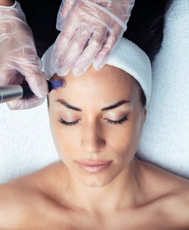 MICRONEEDLING by Dr. Chaitali Mondal in Kolkata MICRONEEDLING-by-Dr MICRONEEDLING-by-Dr Microneedling MICRONEEDLING by Dr